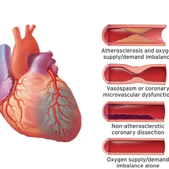 Cardiac/Myocardial Infarction Panel